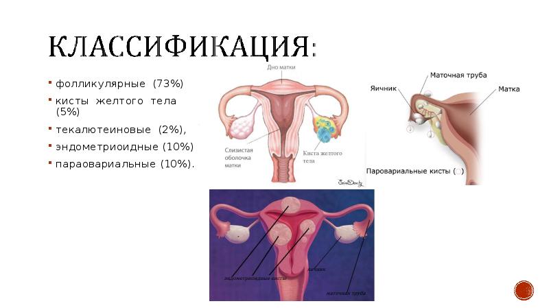 Функциональные кисты яичников презентация