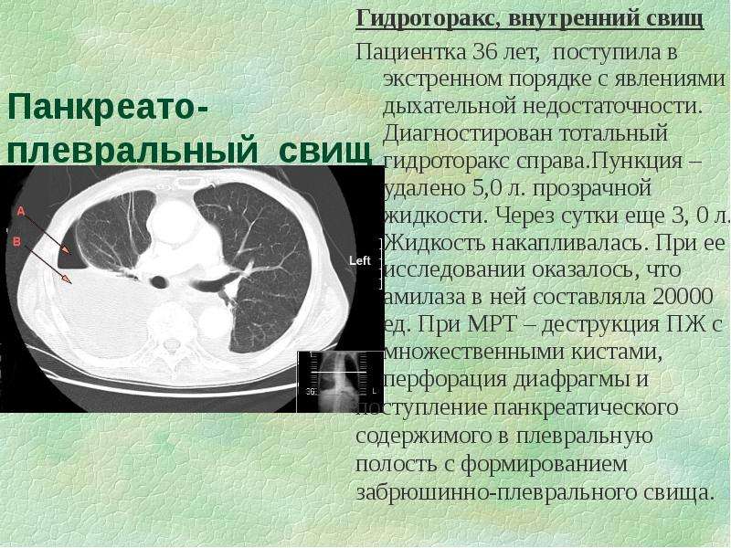 Гидроторакс карта. Гидроторакс на кт. Гидроторакс аускультация. Гидроторакс аускультативно. Тотальный гидроторакс кт.