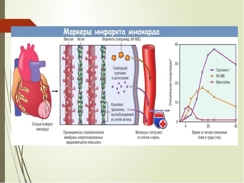 Острый инфаркт миокарда тест нмо