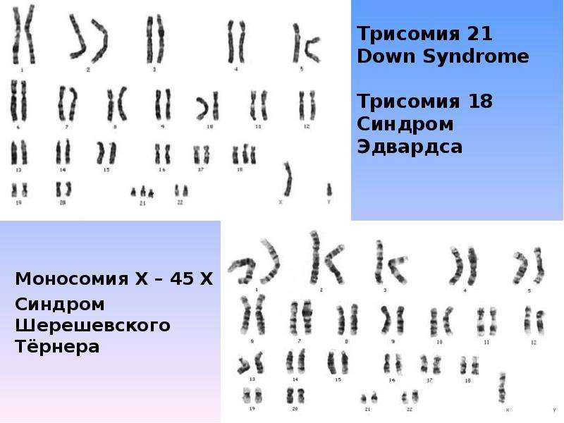 Трисомия это. Анеуплоидия, трисомия, полисомия, моносомия. Анеуплоидия синдром Эдвардса. Трисомия по 21 паре хромосом синдром Шерешевского-Тернера. Трисомия по 18 хромосоме (синдром Эдвардса). Кариотип 47, +18.