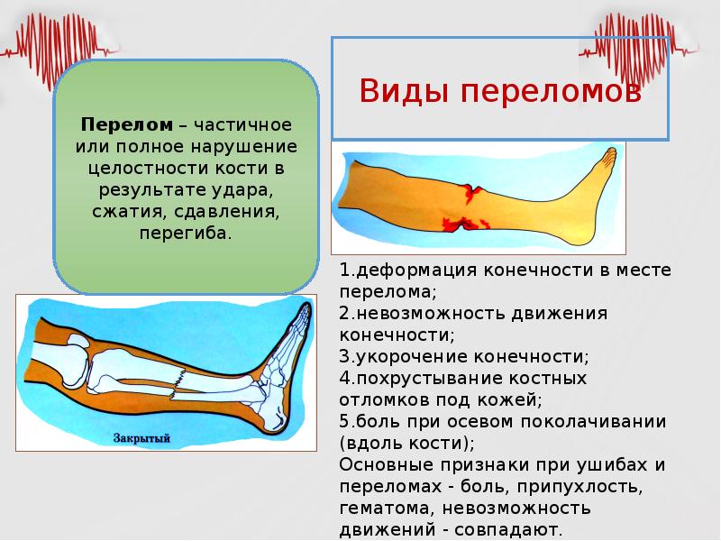 Виды переломов и первая помощь при них