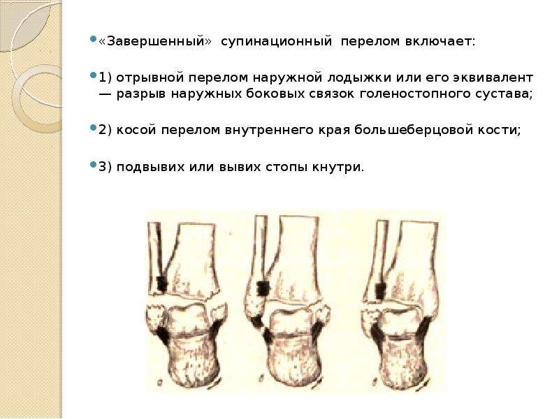 Перелом голеностопа карта вызова