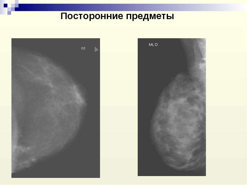 Лучевая диагностика заболеваний молочных желез презентация