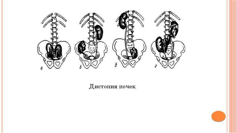 Дистопия почки. Дистопия почки классификация. Гомолатеральная дистопия почки. Поясничная дистопия почки. Тазовая дистопия почки кт.