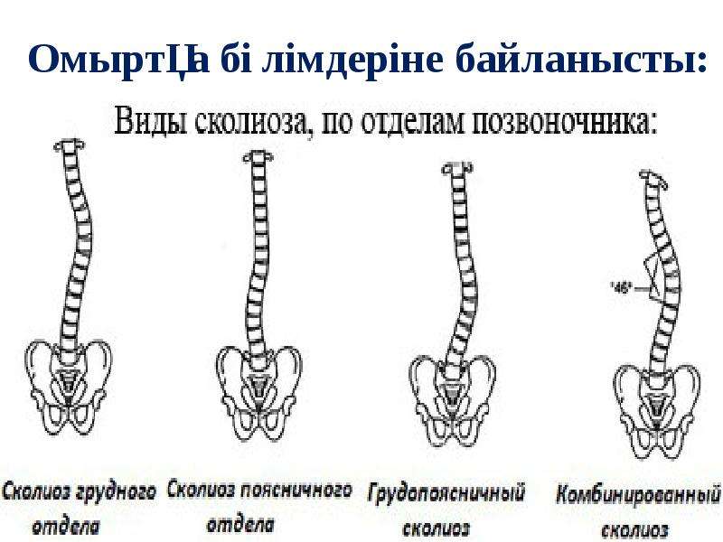 Сколиоз отделов позвоночника. Нейтральный позвонок при сколиозе это. Классификация Ленке сколиоз. Классификация Риго сколиоз.