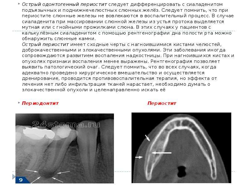 Надкостница зуба. Одонтогенный периостит челюсти.