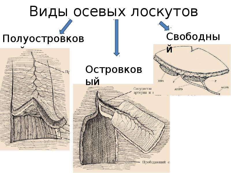 Свободный лоскут. Полуостровковые лоскуты. Классификация кожных Лоскутов.