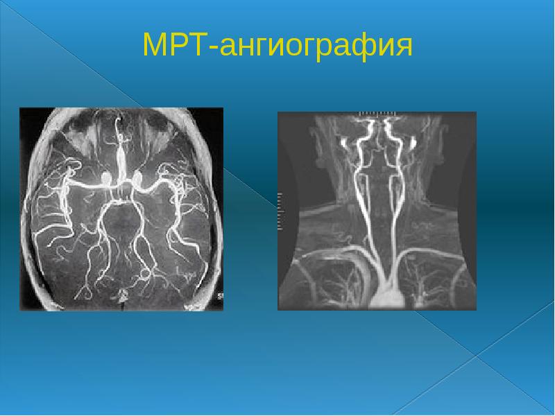 МРТ-ангиография