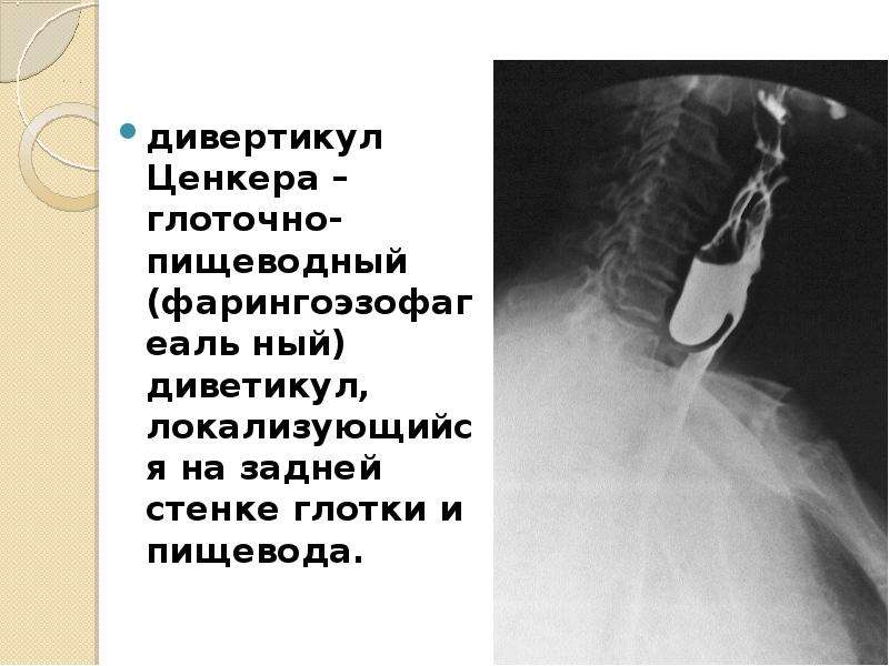 Дивертикул пищевода ценкера