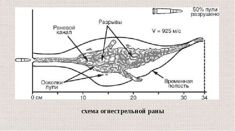 Ломаный канал. Строение раневого канала. Огнестрельное ранение схема.
