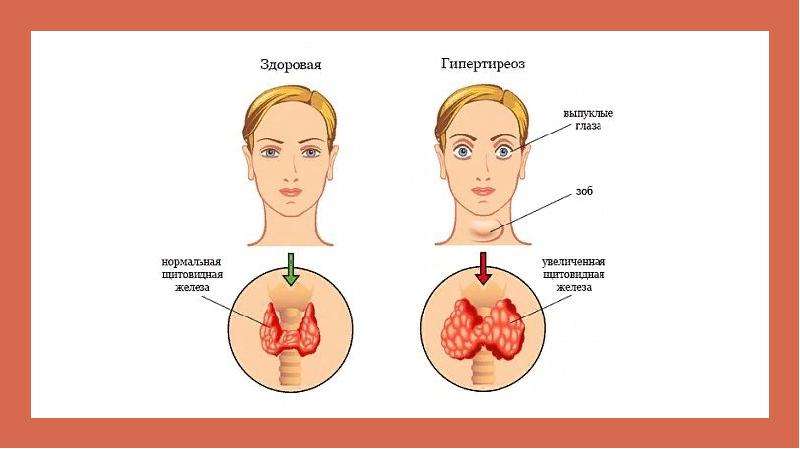 Щитовидная железа гипотиреоз. Гипертиреоз щитовидной железы. Гипертиреоз симптомы у женщин. Гипертиреоз щитовидной железы у женщин.