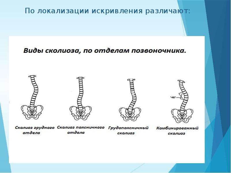 Искривление члена. Типы сколиозов по локализации. Локализация сколиоза. Виды искривления. Виды сколиозов по локализации первичной кривизны:.