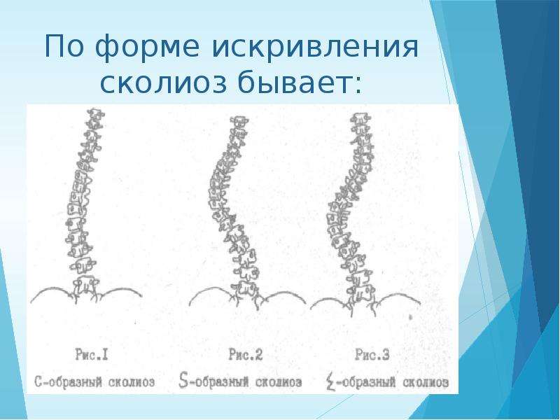 Доклад: Сколиоз 2