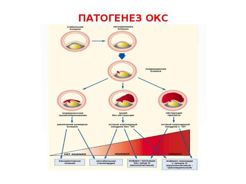 Развитие острого коронарного синдрома