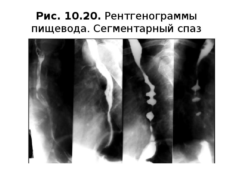 Рентгенография пищевода