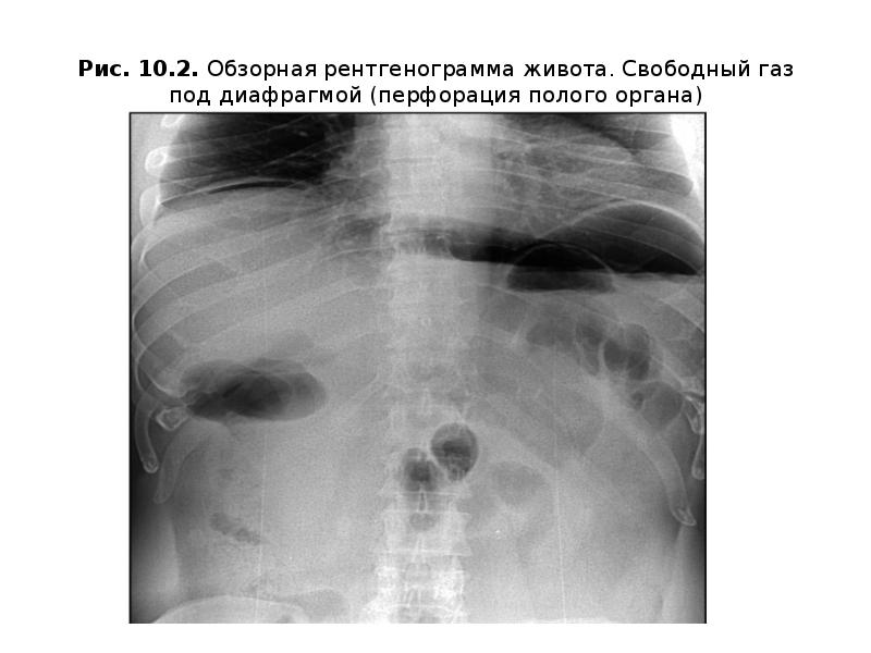 Перфорация полого органа