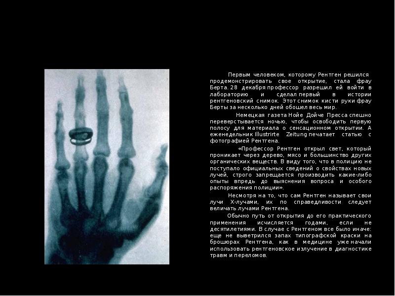 Первым человеком, которому Рентген решился продемонстрировать свое открытие, стала фрау Берта. 28 де