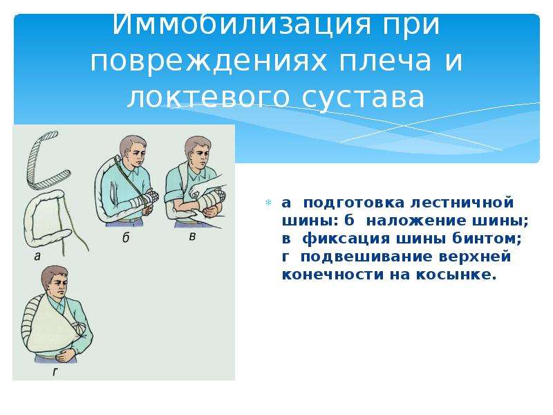 Правила наложения шины. Иммобилизация при травмах. Иммобилизация при травме плеча. Иммобилизация на локоть при переломе. Наложение шины на руку алгоритм.