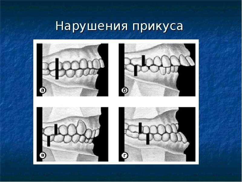 Правильный прикус у человека схема