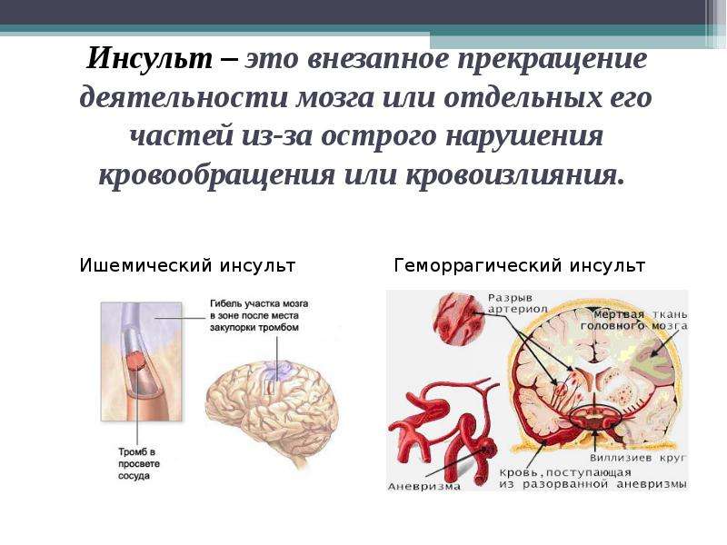 Первая помощь при инсульте фото