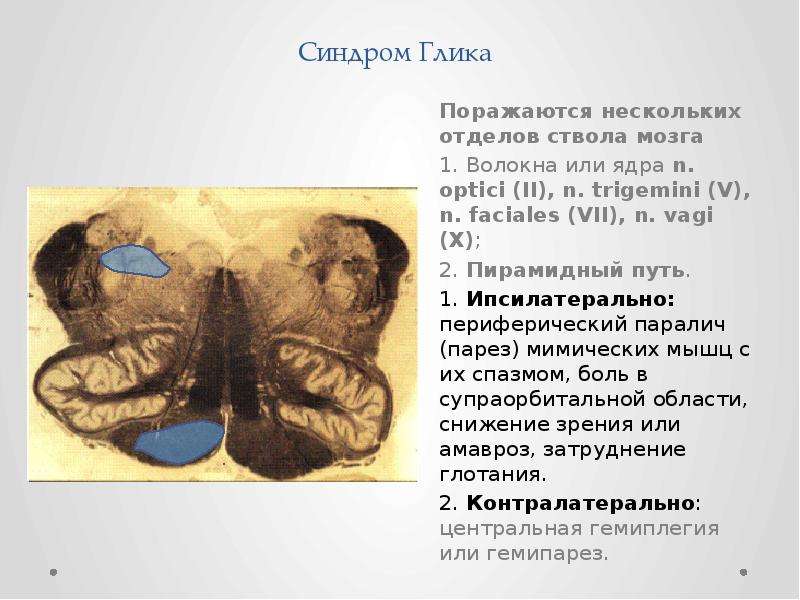 Синдром фовилля. Синдром Глика неврология.