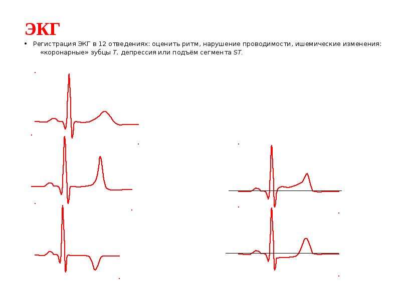 Высокий т на экг причины. Опущение сегмента St на ЭКГ. ЭКГ без подъема сегмента St. Коронарный зубец т на ЭКГ В грудных отведениях.