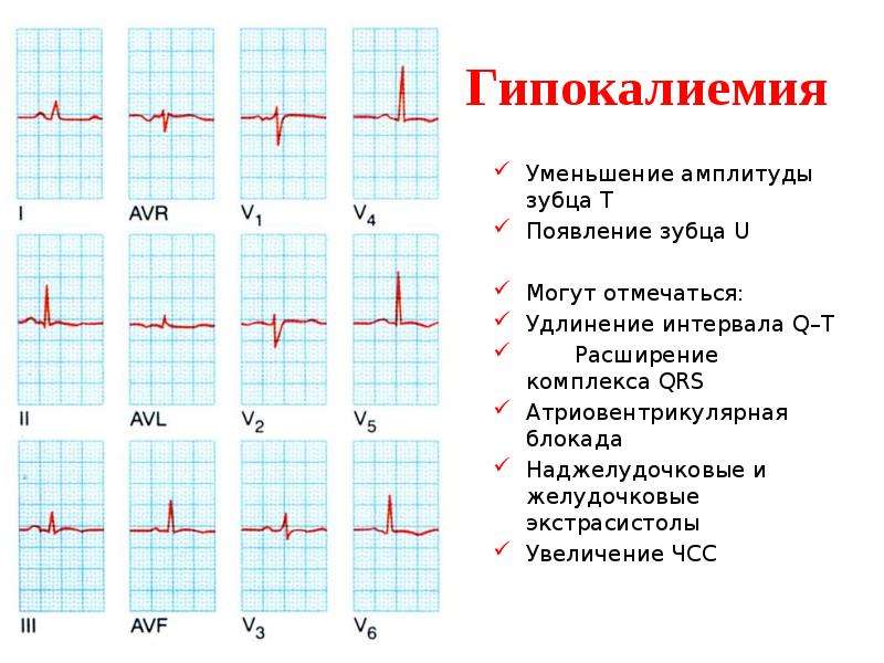 Уменьшение амплитуды. Уменьшение амплитуды зубца т. Снижение амплитуды зубца r на ЭКГ что это такое. Уменьшение амплитуды зубца т на ЭКГ. Снижение амплитуды зубцов т на ЭКГ.