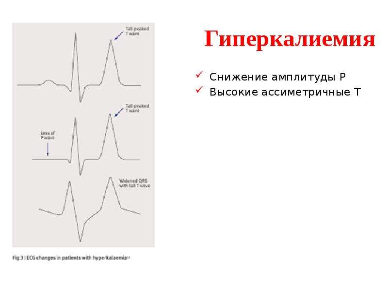 Экг при гиперкалиемии картинки