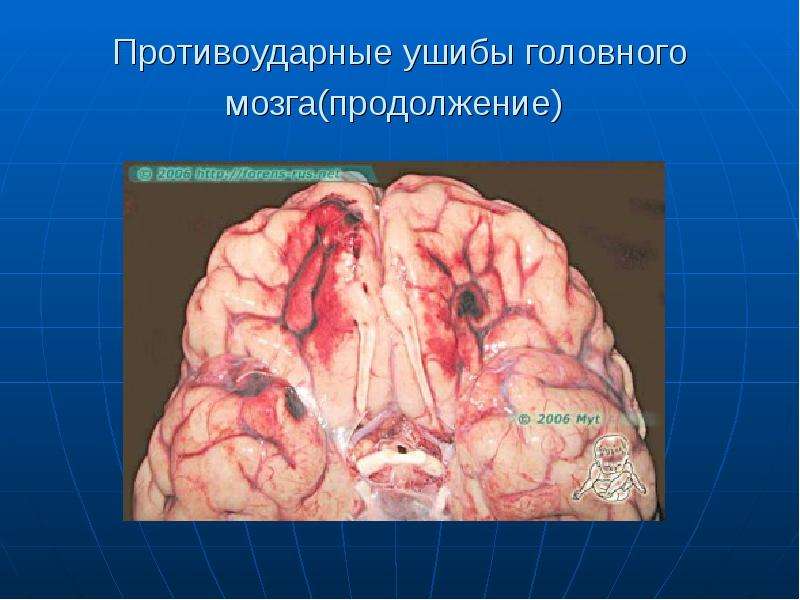 


Противоударные ушибы головного мозга(продолжение) 
