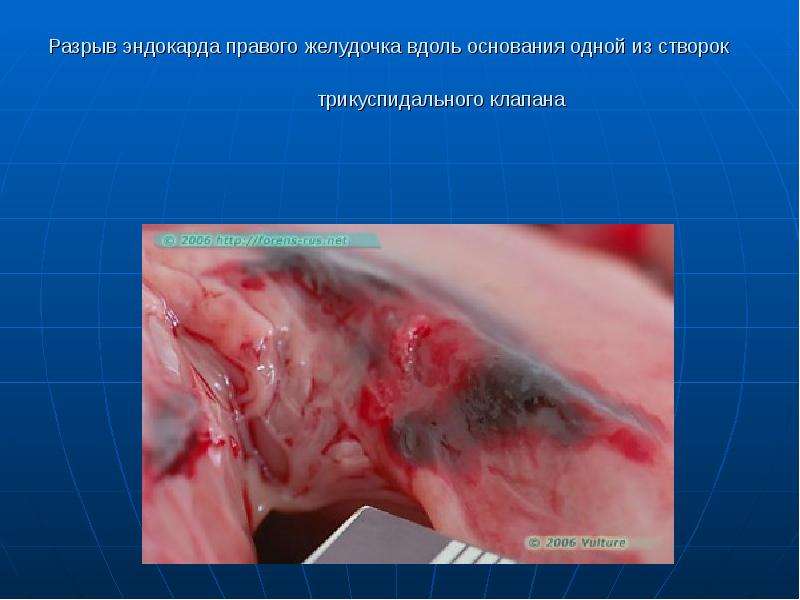 Судебно-медицинская экспертиза при повреждениях от воздействия тупых орудий, слайд №52
