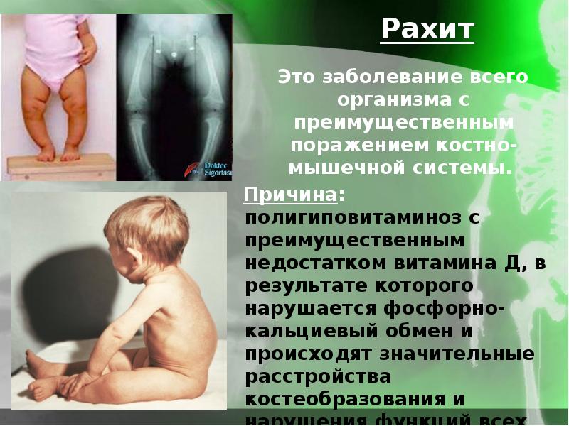 Рахит симптомы. Рахит недостаток витамина д. Рахит при недостатке витамина д. Рахит осложнения витамин д.