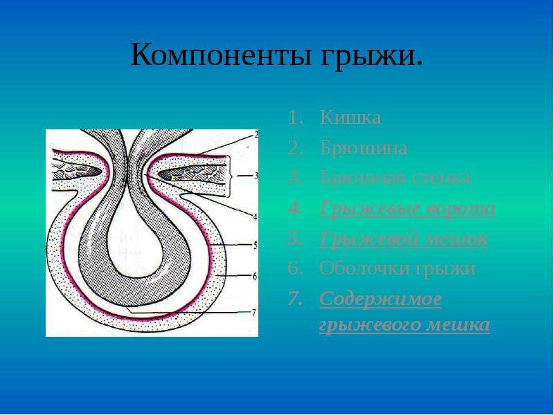 Многокамерный грыжевой мешок. Грыжевые ворота грыжевой мешок. Ущемленная паховая грыжа. Содержимое грыжевого мешка.