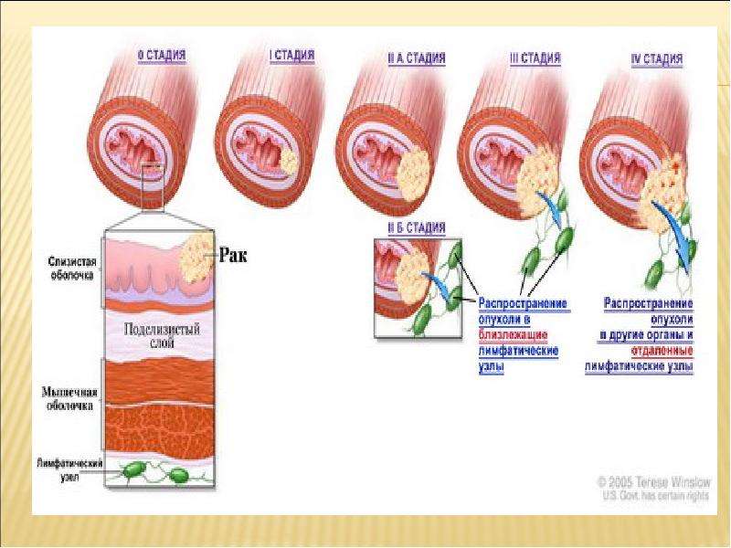 Рак пищевода степени. ТНМ пищевода классификация. TNM пищевода. Онкология пищевода TNM.