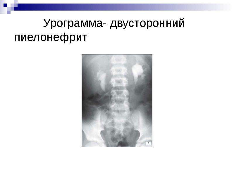   Урограмма- двусторонний        пиелонефрит
