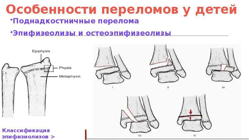 Переломы у детей. Классификация переломов у детей. Поднадкостничные переломы у детей. Особенности переломов костей у детей раннего возраста. Переломы у детей по типу.