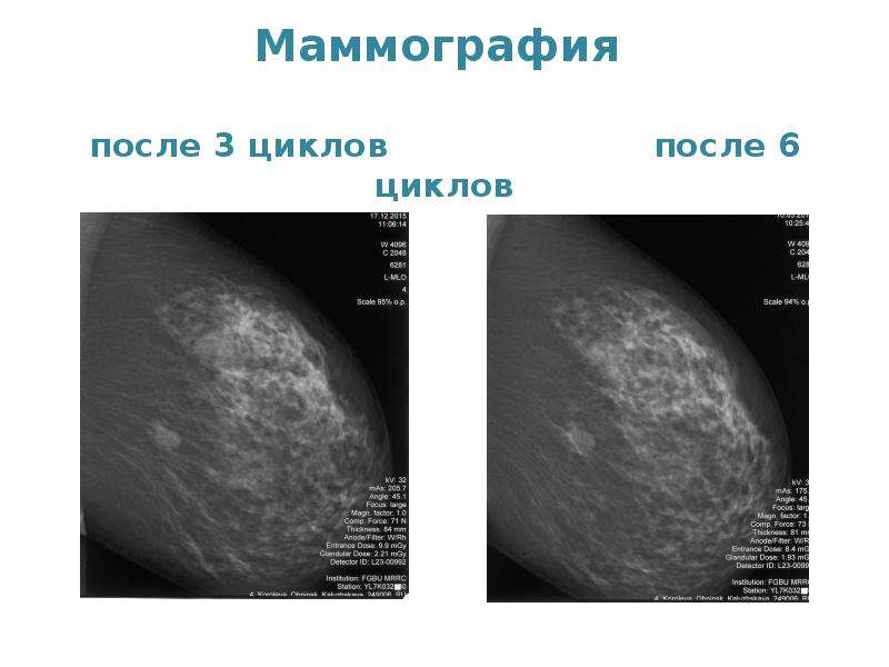 Каком дне цикла делают маммографию. Маммография презентация. Маммография периодичность.