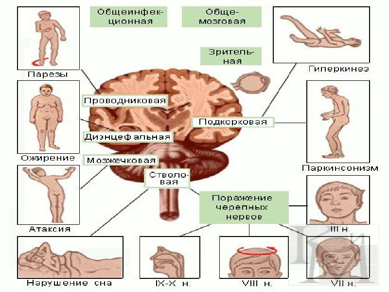 Энцефалит головного мозга у взрослых. Классификация энцефалитов неврология. Энцефалиты классификация патогенез. Энцефалиты (этиология, классификация). Герпетический энцефалит классификация.