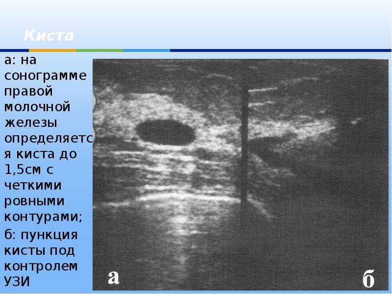 Кисты в молочных железах чем опасны. Киста молочной железы на УЗИ. Сложная киста молочной железы на УЗИ. Единичная киста молочной железы. Доброкачественные образования молочной железы УЗИ.