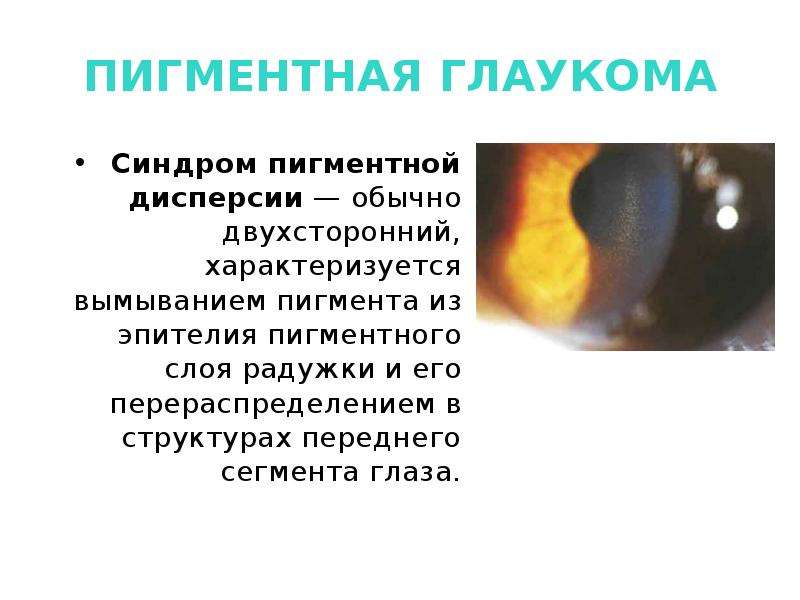 Дисперсия глаза. Синдром пигментной дисперсии. Пигментная открытоугольная глаукома. Синдром пигментной дисперсии глаза.