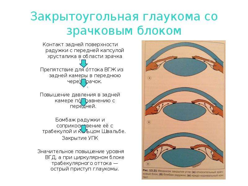 Острая глаукома карта вызова