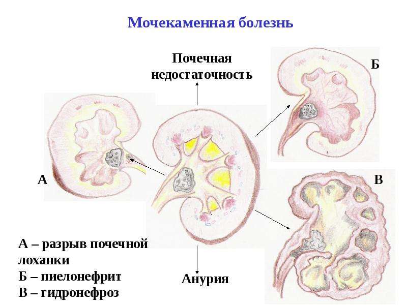 Мочекаменная болезнь картинки для презентации