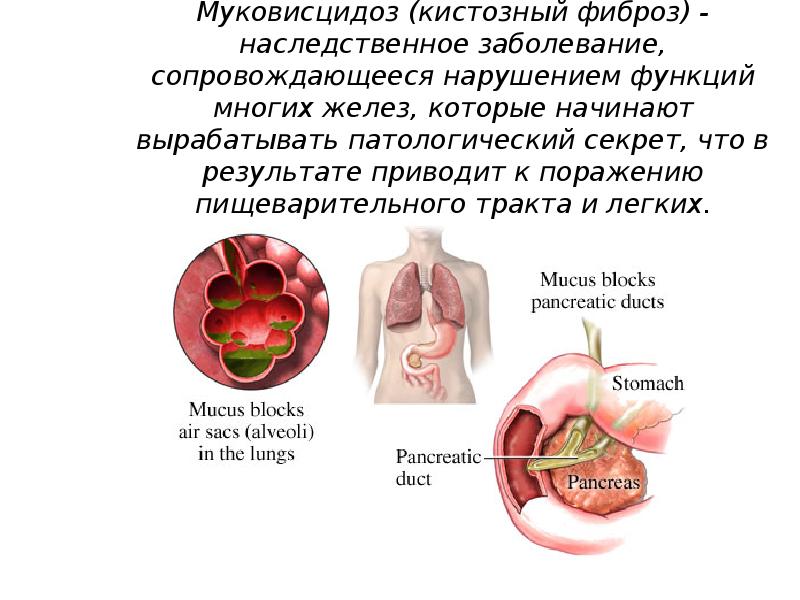 Кистозный фиброз фото