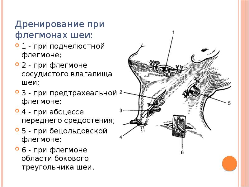 Вскрытие флегмоны шеи. Разрезы при флегмонах и абсцессах шеи. Дренирование абсцессов и флегмон шеи.