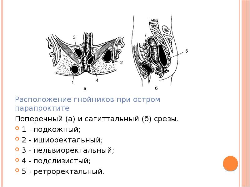 Хронический парапроктит презентация