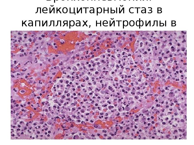 


Бронхопневмония: лейкоцитарный стаз в капиллярах, нейтрофилы в альвеолах 
