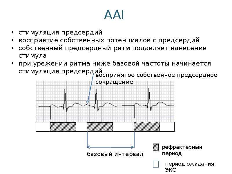 Режимы работы экс. Экс в режиме VVI. ЭКГ В режиме VVI. Режим Aai кардиостимулятора. Ритм кардиостимулятора на ЭКГ.