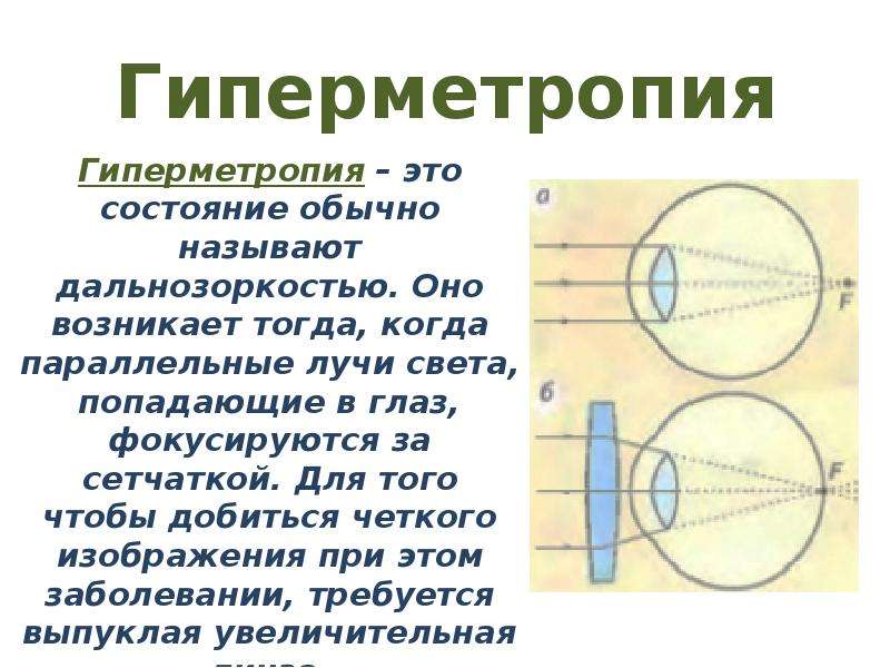 Гиперметропия. Дальнозоркость (гиперметропия).