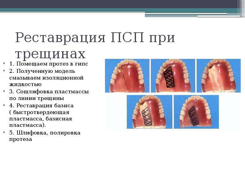 Перелом протеза. Причины переломов базисов протезов. Этапы Починки съемного протеза. Перелом базиса съемного протеза. Починка съемного протеза.