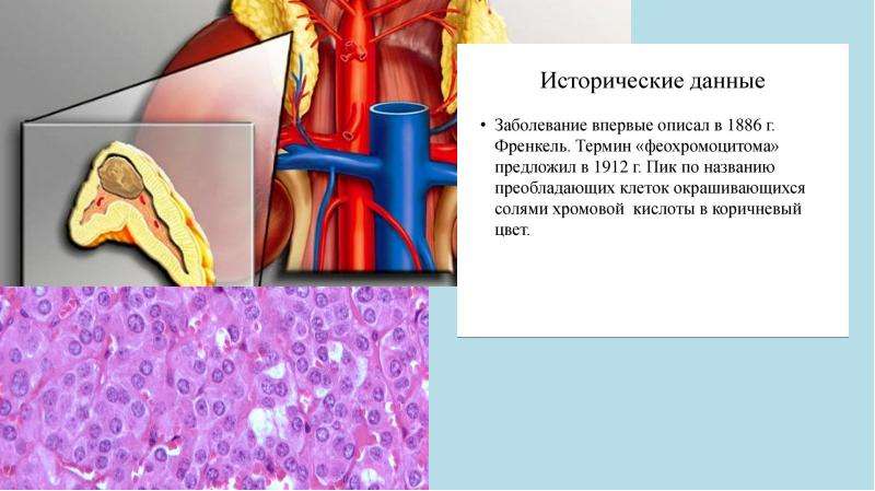 Феохромоцитома у детей презентация