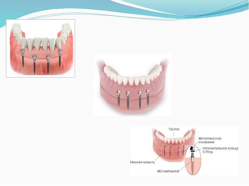 Дентальная имплантация презентация